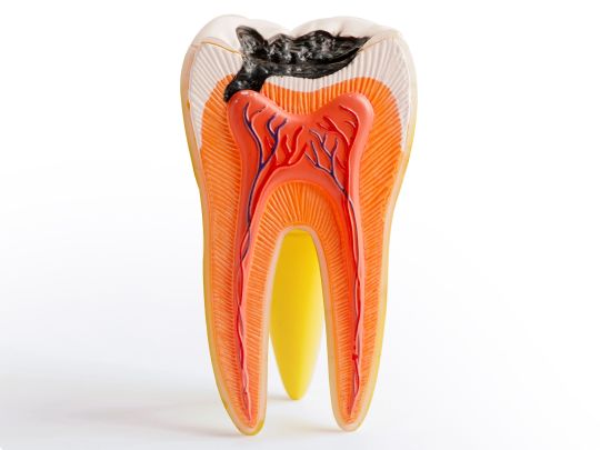 caries